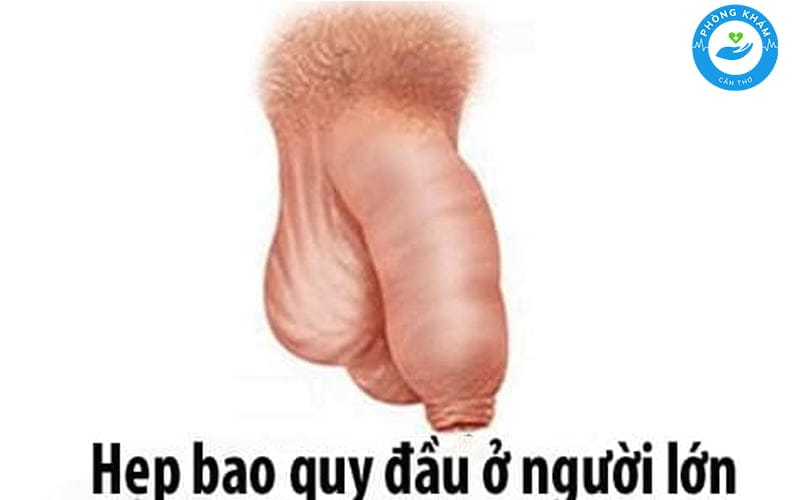 Hẹp bao quy đầu ở nam giới