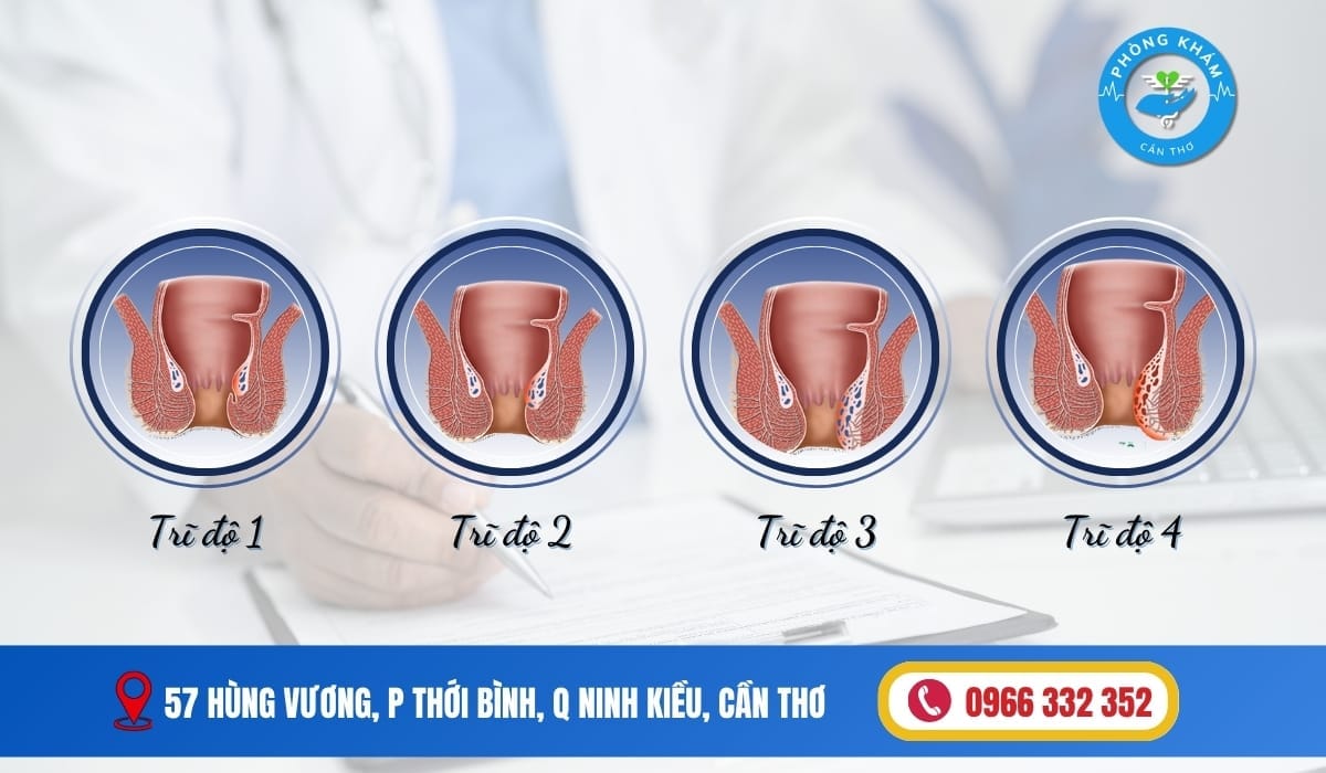 Búi Trĩ Sa Ra Ngoài Phải Làm Sao  - Các Cấp Độ Sa Búi Trĩ Thường Gặp