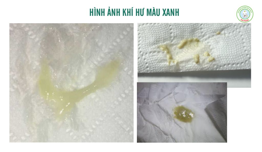 Hình ảnh khí hư màu xanh có mùi hôi