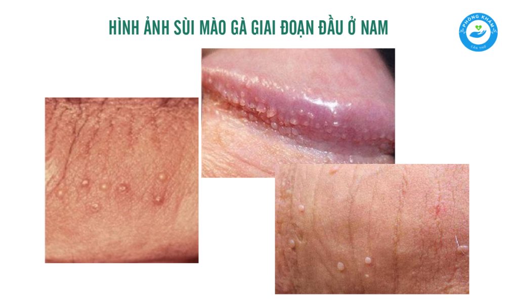 Hình ảnh sùi mào gà giai đoạn đầu ở nam