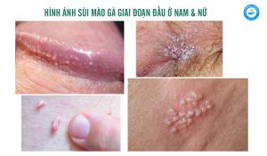 Hình ảnh sùi mào gà giai đoạn đầu ở nam và nữ