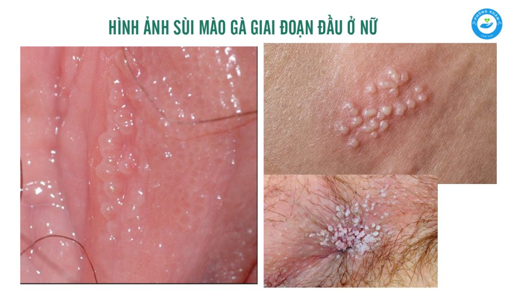 Hình ảnh sùi mào gà giai đoạn đầu ở nữ