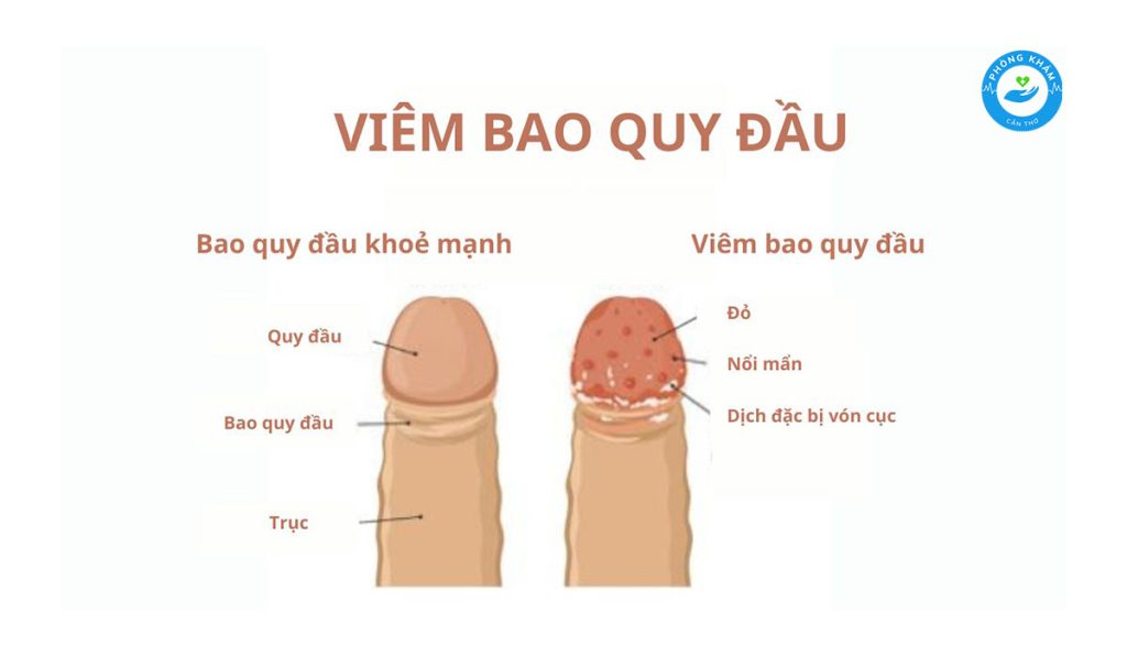 Viêm bao quy đầu là 1 trong những nguyên nhân gây mụn đỏ đầu dương vật ở nam giới