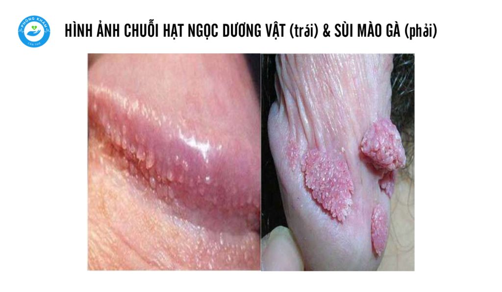 Hình ảnh phân biệt sùi mào gà và chuỗi hạt ngọc dương vật
