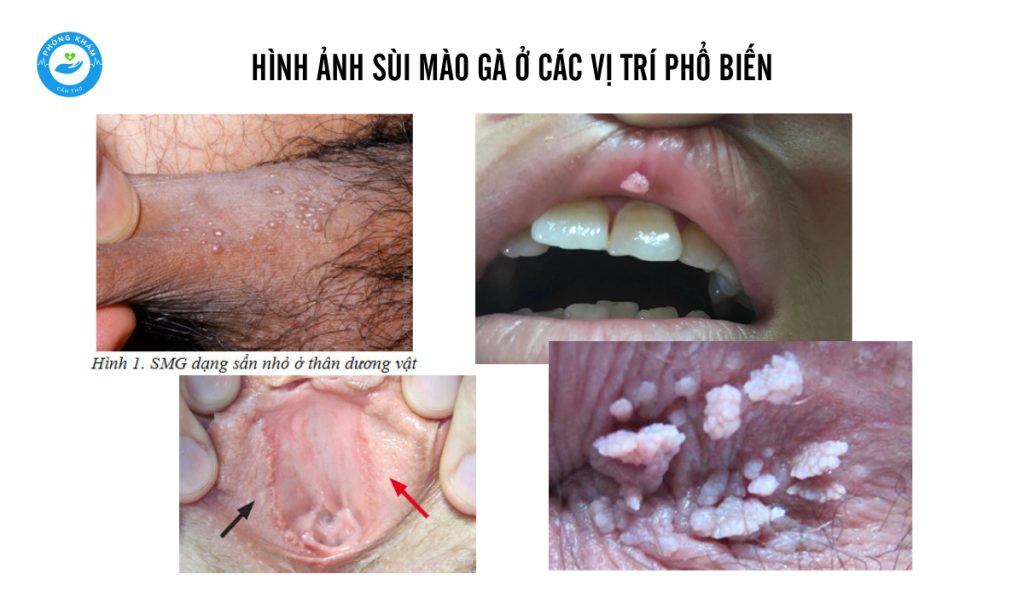 Hình ảnh sùi mào gà ở các vị trí phổ biến trên cơ thể