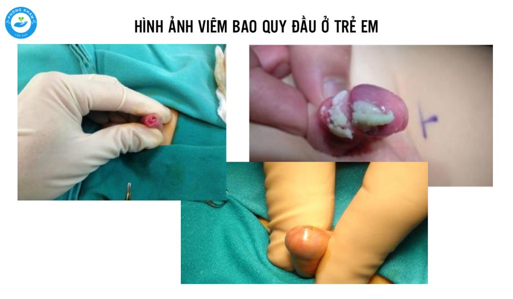 Hình ảnh viêm bao quy đầu ở trẻ em