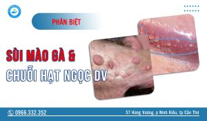 Phân biệt sùi mào gà và chuỗi hạt ngọc dương vật