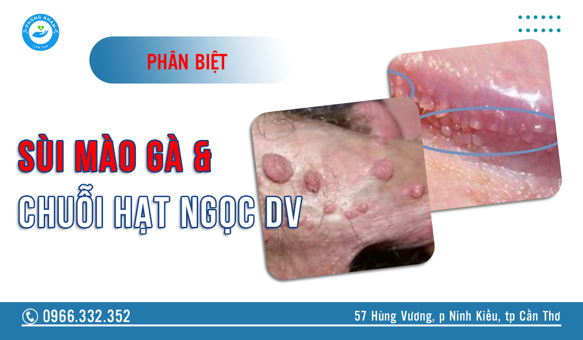 Phân biệt sùi mào gà và chuỗi hạt ngọc dương vật