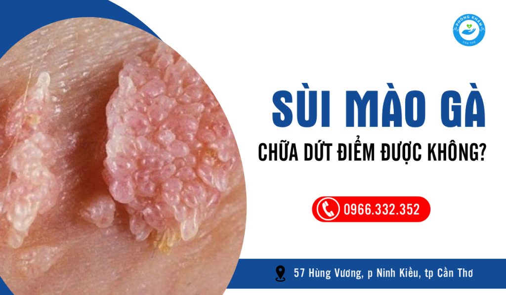 Sùi mào gà có chữa dứt điểm được không?