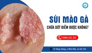 Sùi mào gà có chữa dứt điểm được không?