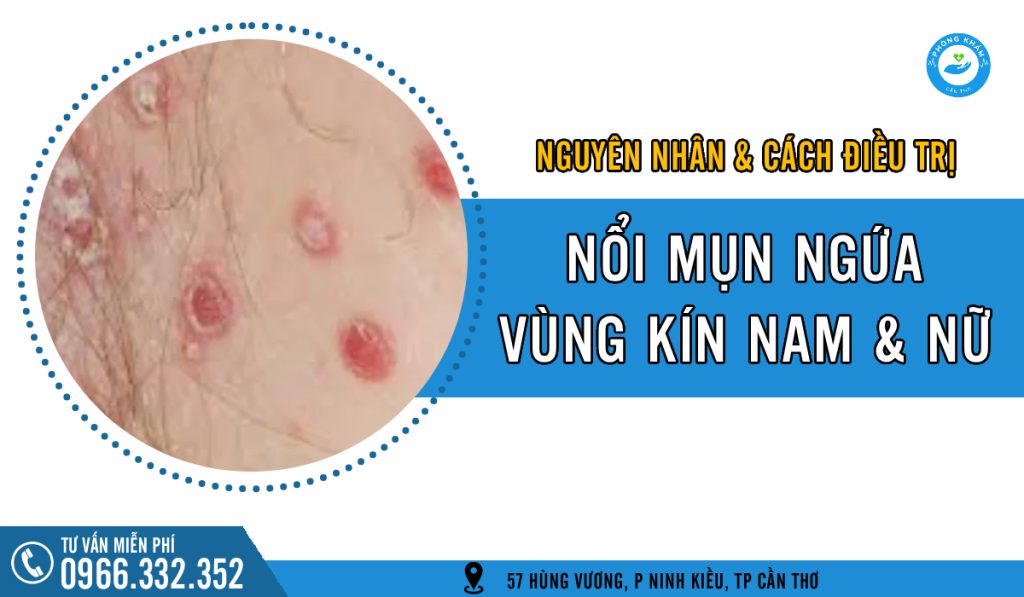 Nổi mụn ngứa vùng kín: Nguyên nhân và cách điều trị hiệu quả