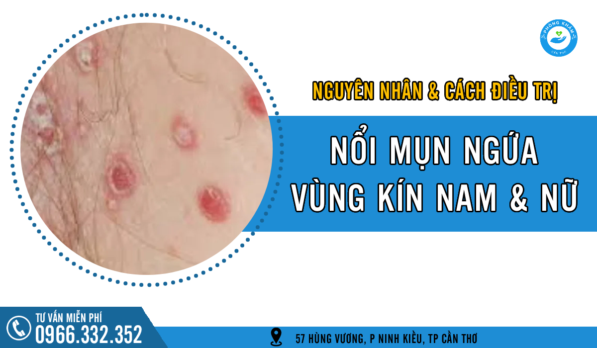 Nổi mụn ngứa vùng kín: Nguyên nhân và cách điều trị hiệu quả