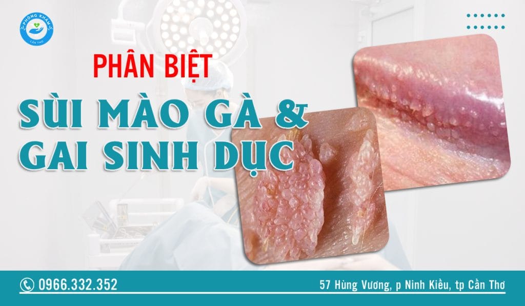 Phân biệt sùi mào gà và gai sinh dục