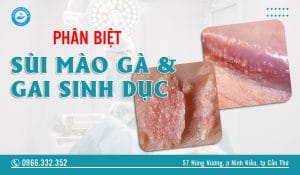 Phân biệt sùi mào gà và gai sinh dục