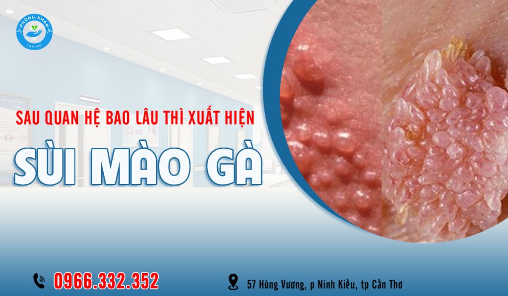 Sau quan hệ bao lâu thì nổi sùi mào gà?