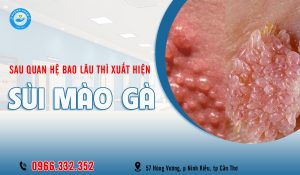 Sau quan hệ bao lâu thì nổi sùi mào gà?