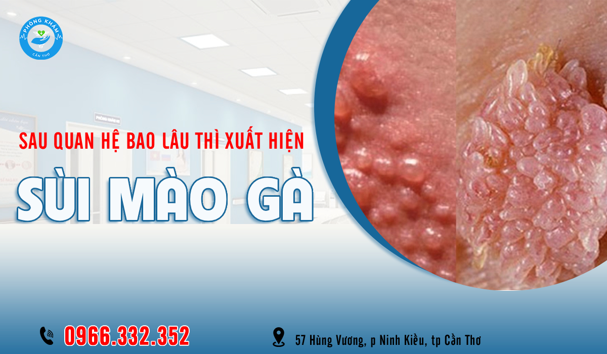 Sau quan hệ bao lâu thì nổi sùi mào gà?
